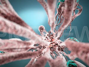 static cancer 3D 모델