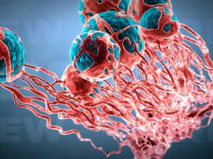 cancer growth 2 static hipoly 3D Model