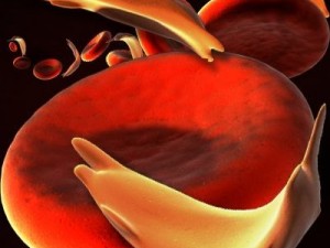 blood cells sickle anemia also 3D Model
