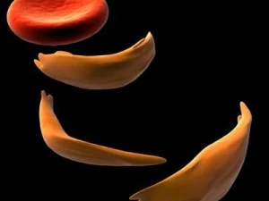 blood cells sickle anemia also 3D Model