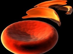 blood cells sickle anemia also Modèle 3D