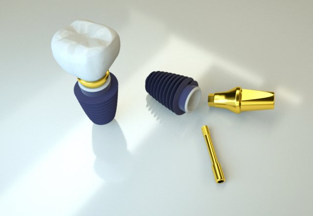 dental implant 3D Model .c4d .max .obj .3ds .fbx .stl .blend 