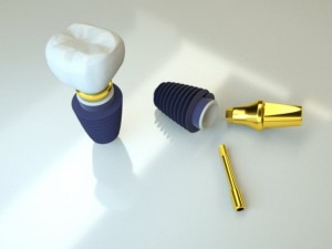 dental implant 3D 모델