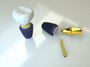 dental implant 3D Model