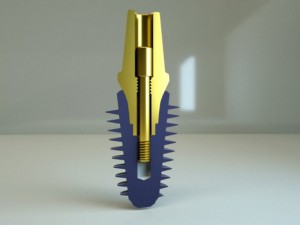 dental implant 3D Model