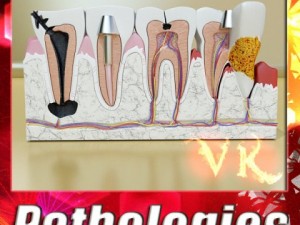 teeth pathologies high detail 3D Model