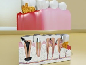 teeth pathologies high detail 3D Model