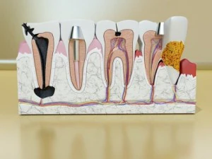 teeth pathologies high detail 3D Model