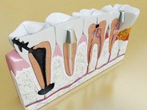 teeth pathologies high detail 3D Модель