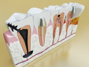 teeth pathologies high detail 3D Model