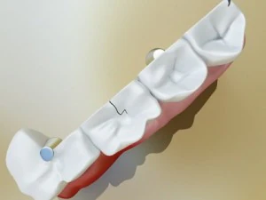 teeth pathologies high detail 3D Model