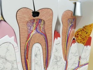 teeth pathologies high detail 3D Model