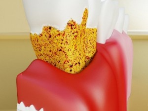 teeth pathologies high detail 3D Модель