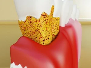 teeth pathologies high detail 3D Model