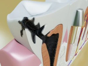 teeth pathologies high detail 3D Model
