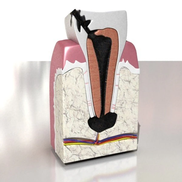 decayed tooth 3D Model .c4d .max .obj .3ds .fbx .stl .blend 