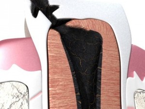 decayed tooth 3Dモデル