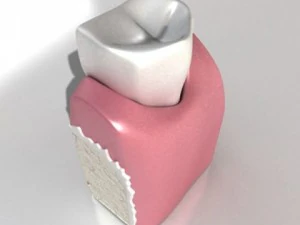 decayed tooth 3D Model