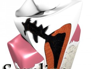 decayed tooth 3Dモデル