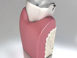 decayed tooth 3D Model