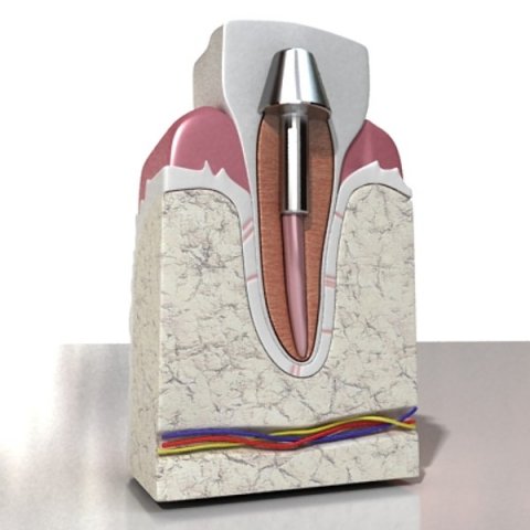 dental implant 3D Модель .c4d .max .obj .3ds .fbx .stl .blend 