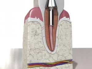 implan gigi Model 3D