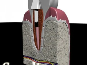 dental implant 3D Model