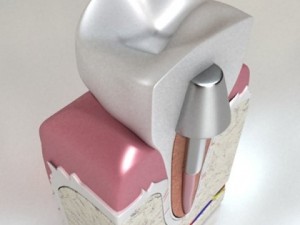 dental implant 3D Модель