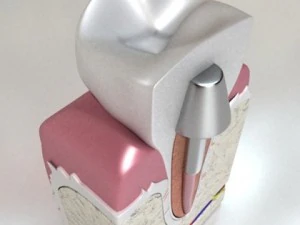 dental implant 3D Model