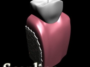 dental implant 3D Модель