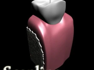 dental implant 3D Model