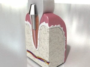 dental implant 3D Model