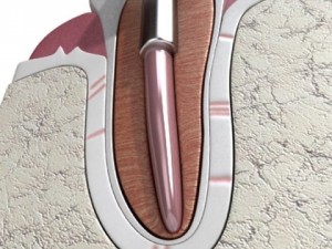 dental implant 3D Модель