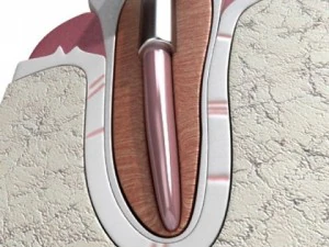 dental implant 3D Model