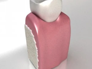 dental implant 3D Model