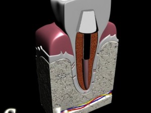 dental implant 3D Модель