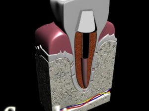 dental implant 3D Model