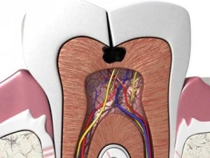 cracked tooth high detail 3D Model