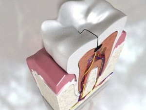 cracked tooth high detail Modèle 3D