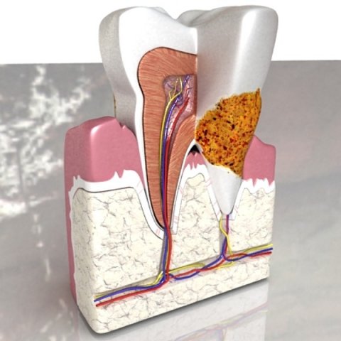 tooth dental plaque high detail 3D 모델 .c4d .max .obj .3ds .fbx .stl .blend 