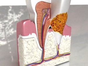 tooth dental plaque high detail 3D Model