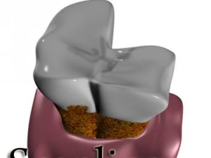 tooth dental plaque high detail 3D Model