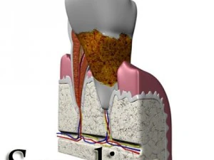 tooth dental plaque high detail 3D Model