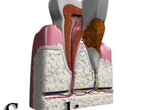 tooth dental plaque high detail 3D 모델