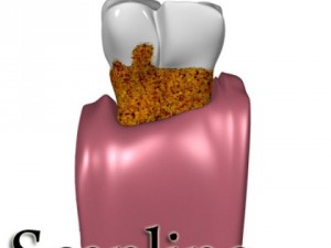 tooth dental plaque high detail 3D 모델