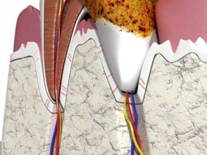 tooth dental plaque high detail 3D 모델