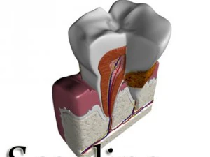 tooth dental plaque high detail 3D Model