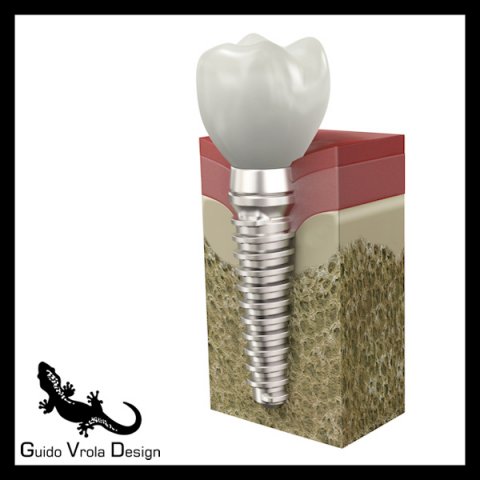 dental implant Modelo 3D .c4d .max .obj .3ds .fbx .stl .blend 