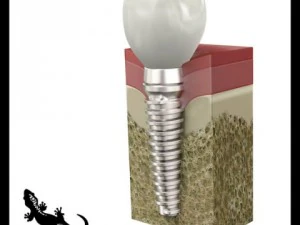 歯科インプラント 3Dモデル