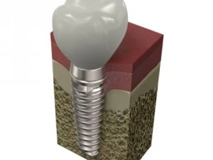 dental implant 3D Model